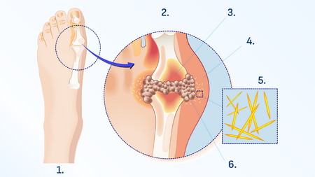 1. articulação saudável,2. articulação afetada pela gota, 3.Inflamação,4. Inchaço,5. Cristais de ácido úrico,6. Deposição de ácido úrico