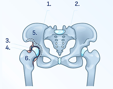 A articulação da anca.1. Acetábulo,2. sacro,3. Cabeça do fémur,4. cápsula articular,5. Osso da anca,6. fémur