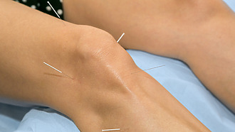 A acupunctura pode ser utilizada no tratamento da artrose do joelho.