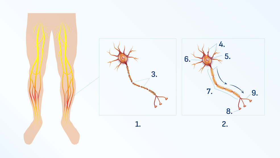 A diferença entre uma célula nervosa saudável e uma danificada por neuropatia