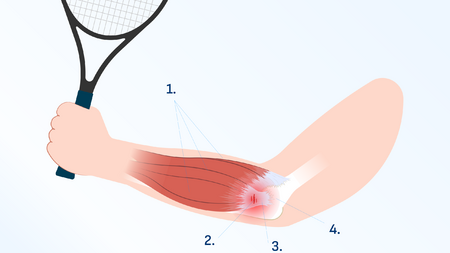 Cotovelo de tenista 1. Extensores, 2. Tendão rompido ou inflamado, 3. Tendão, 4. Cotovelo de tenista - epicondilite lateral
