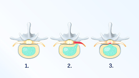 Protrusão do disco intervertebral - uma das possíveis causas de dores nas costas. A diferença entre um disco saudável Figura 1 e uma hérnia discal Figura 2 e 3